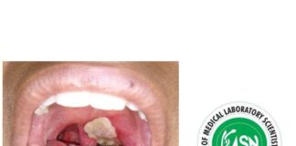 Diphtheria: AMLSN issues red alert to Medical Lab. Scientists