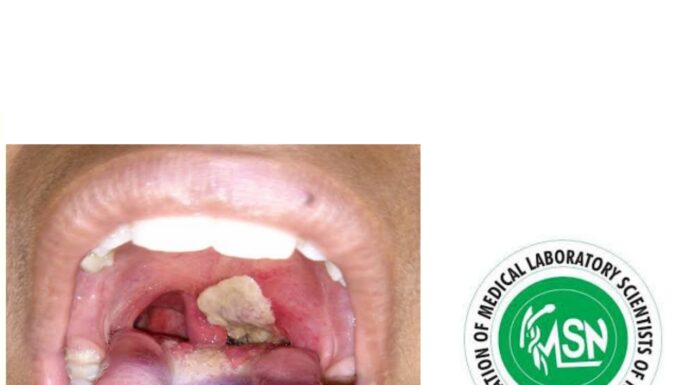Diphtheria: AMLSN issues red alert to Medical Lab. Scientists